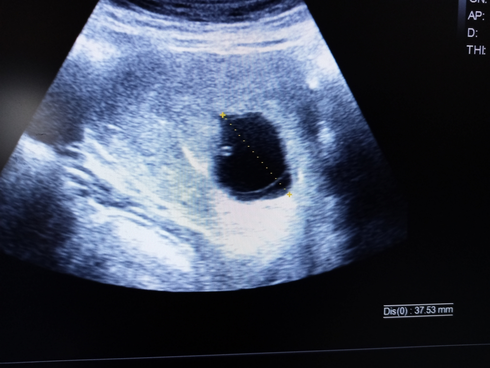 Tuščia gemalinė pūslelė